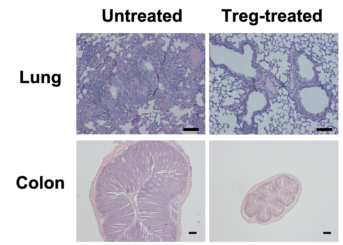 Views of lung and colon tissue under a microscope showing the therapeutic potential of Treg cells in inhibiting inflammation in the lung and gut. Treg-treated tissues show less inflammation.